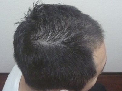 40代男性 右側頭部 1ヵ月