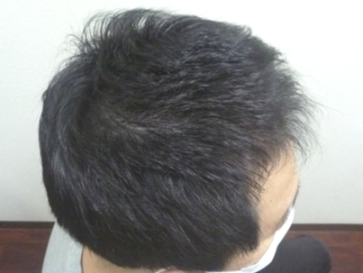 40代男性 右側頭部 4ヵ月