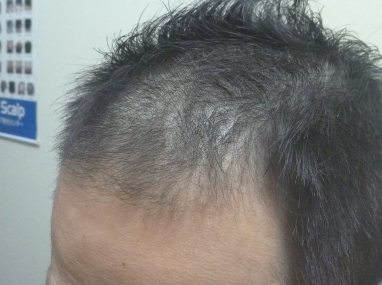 40代男性 生え際 1ヵ月