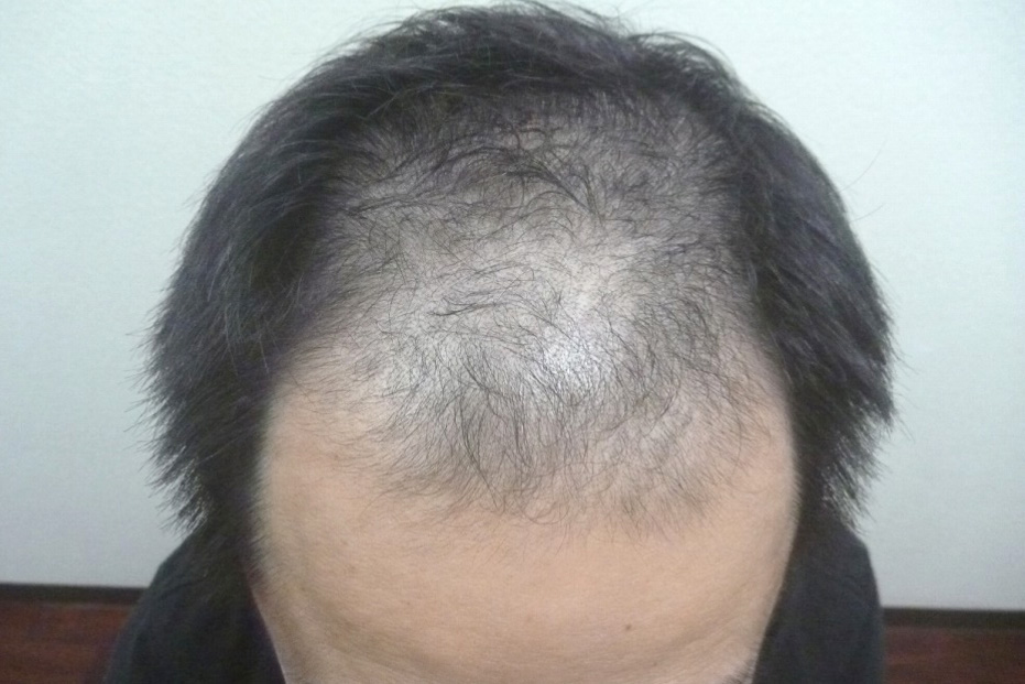 40代男性 前頭部 スタート