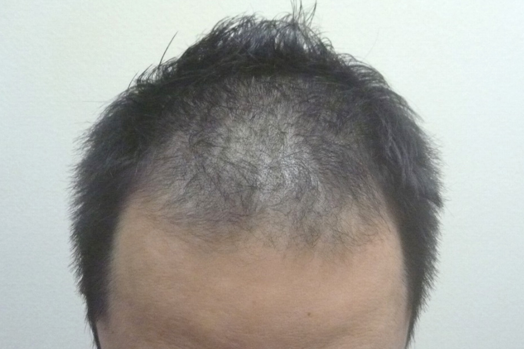 40代男性 前頭部 1ヵ月