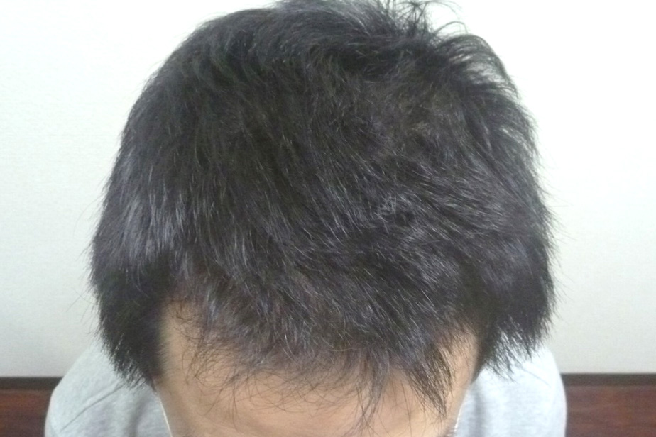 40代男性 前頭部 4ヵ月