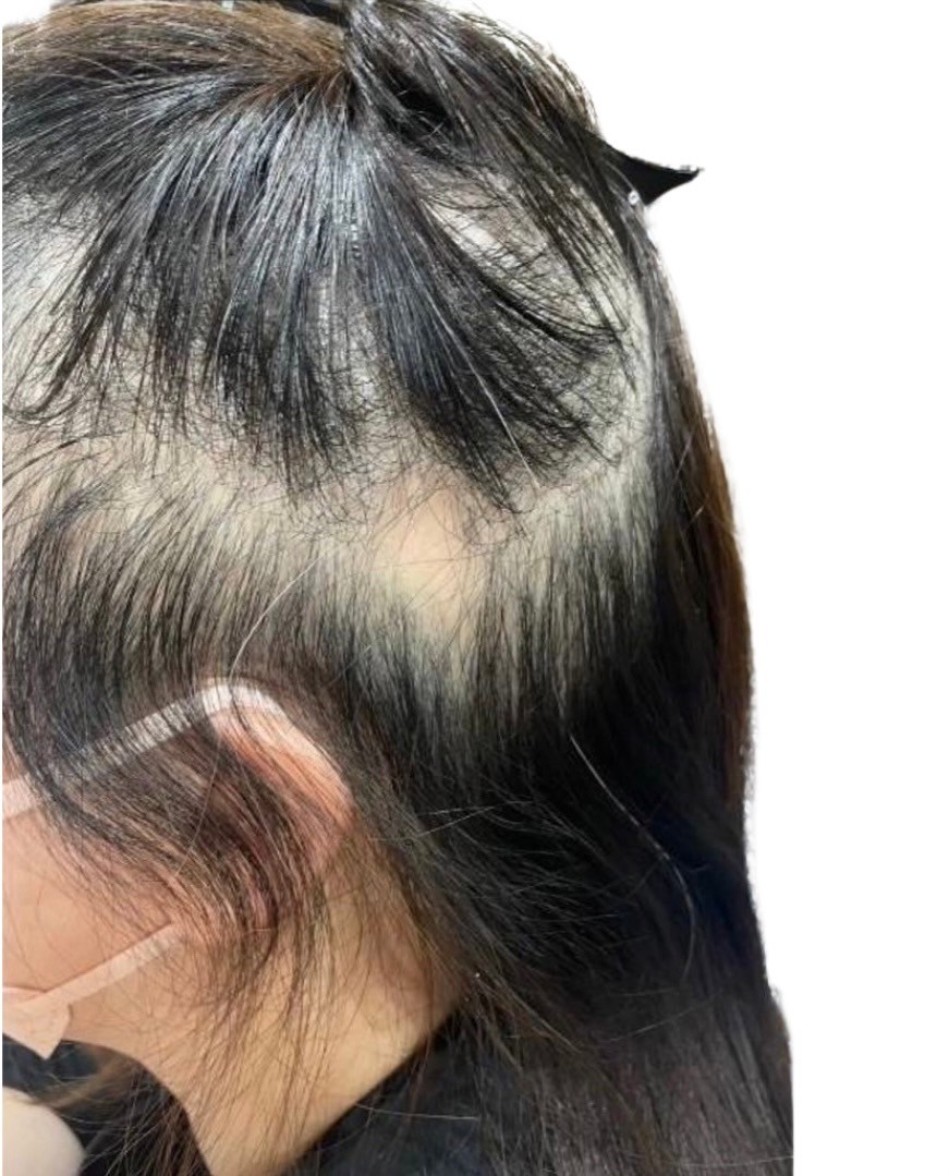 40代女性 側頭部左 スタート