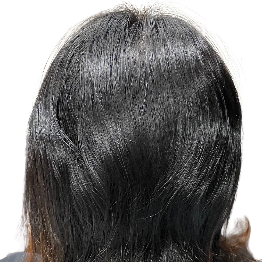 40代女性 後頭部 4ヵ月