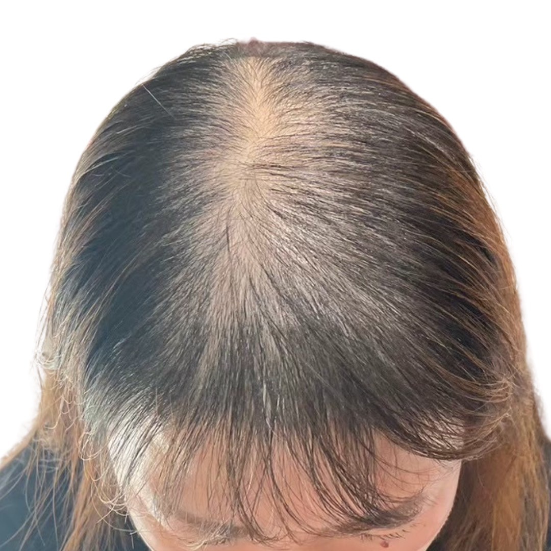 40代女性 頭頂部 スタート