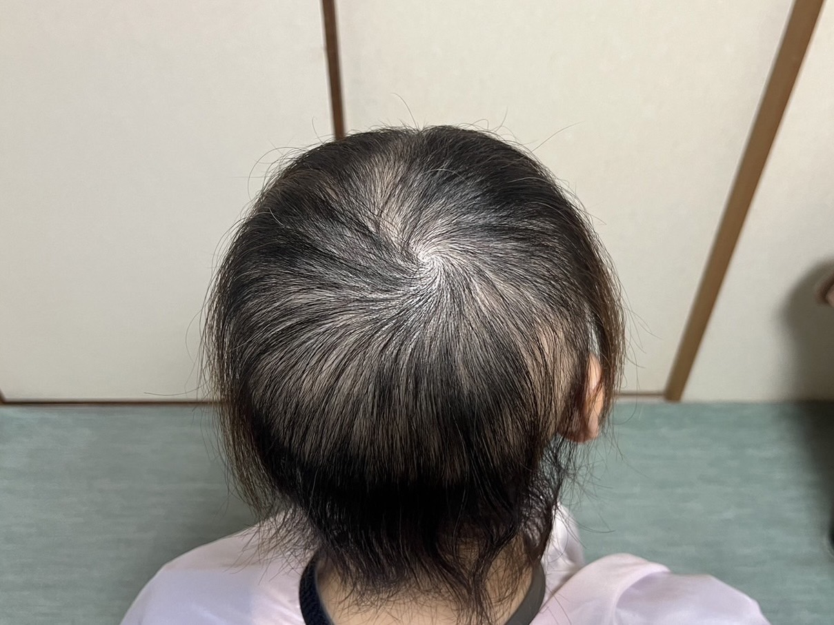 Before 30代女性