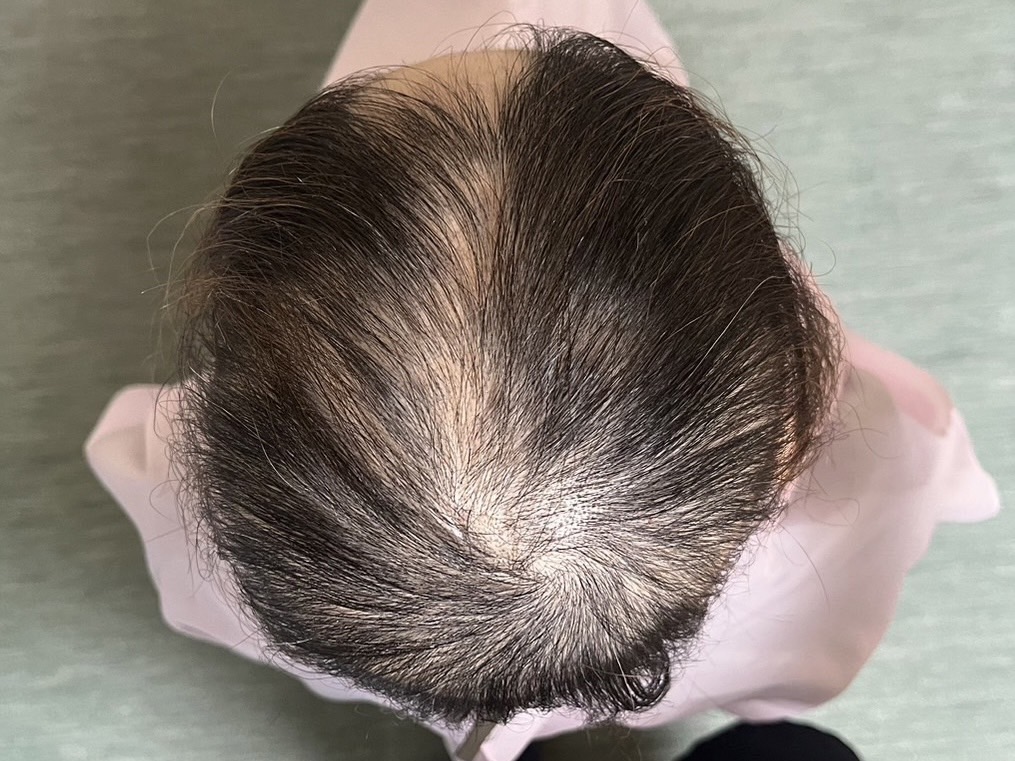 30代女性 頭頂部 スタート