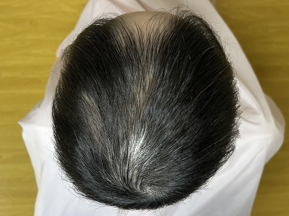 30代女性 頭頂部 途中