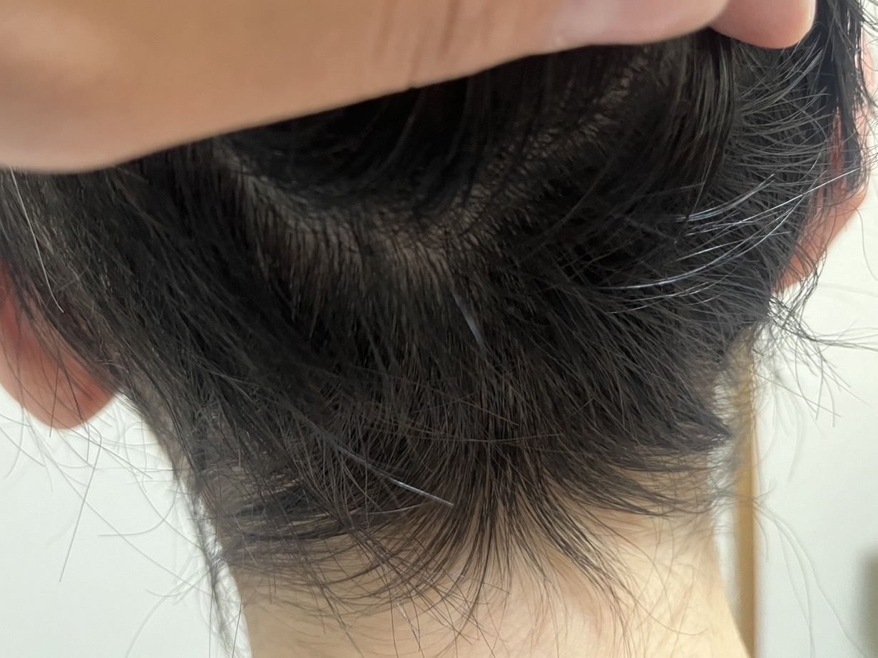 30代女性 後頭部 3ヵ月