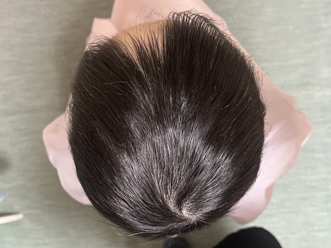 30代女性 頭頂部 3ヵ月