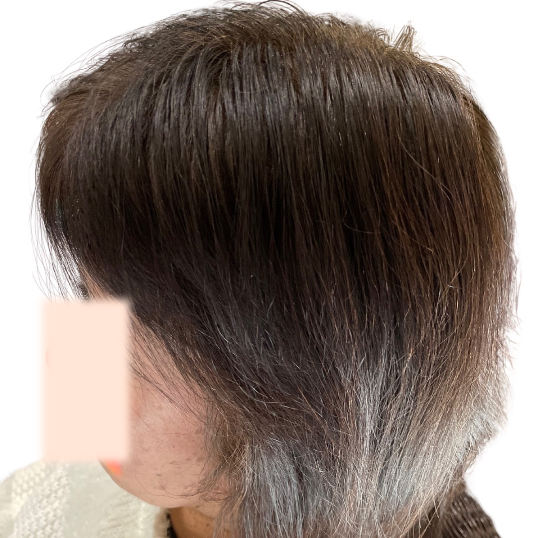 50代女性 側頭部左 4ヵ月