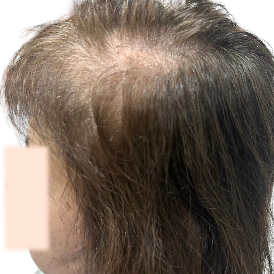 50代女性 側頭部左 スタート
