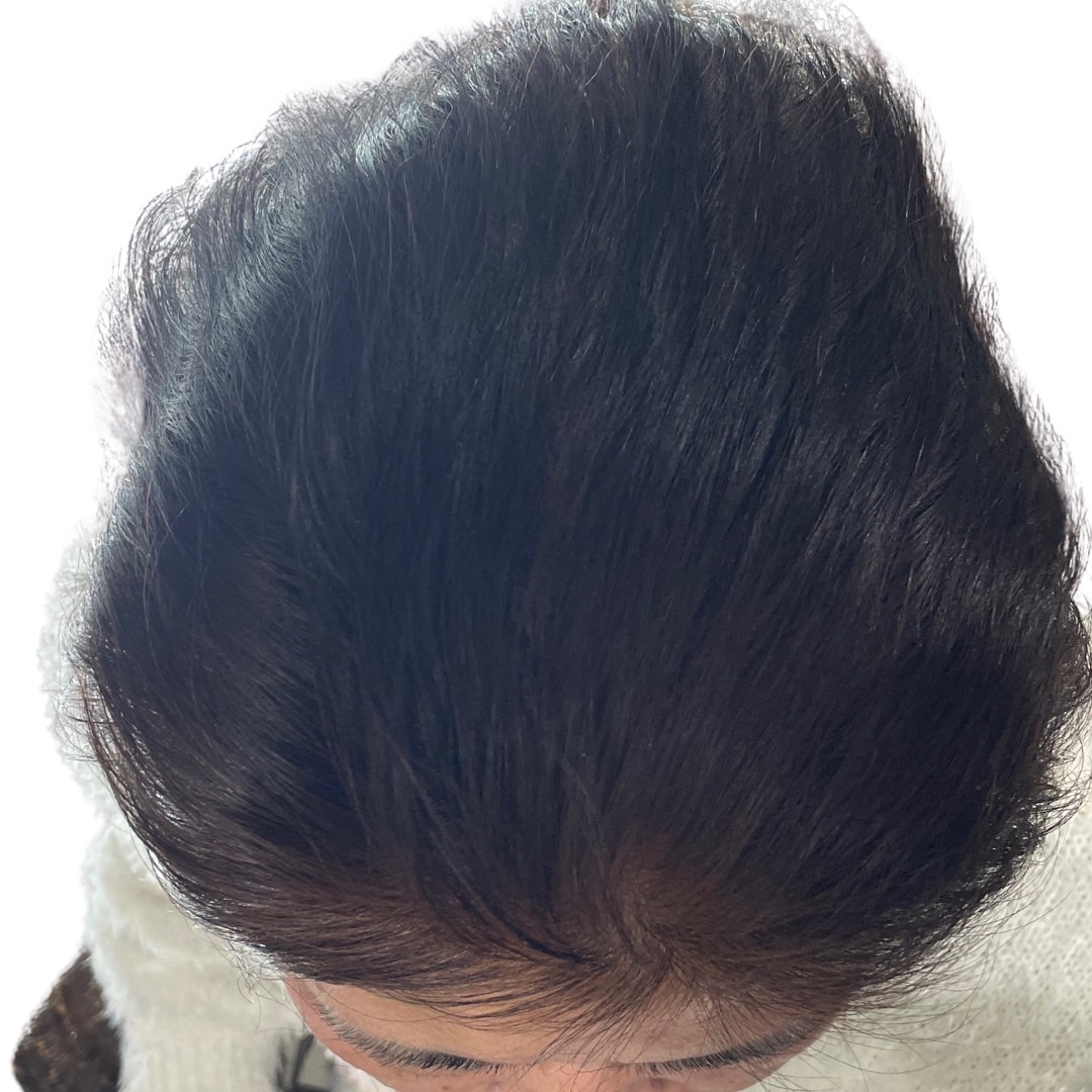 50代女性 頭頂部 4ヵ月