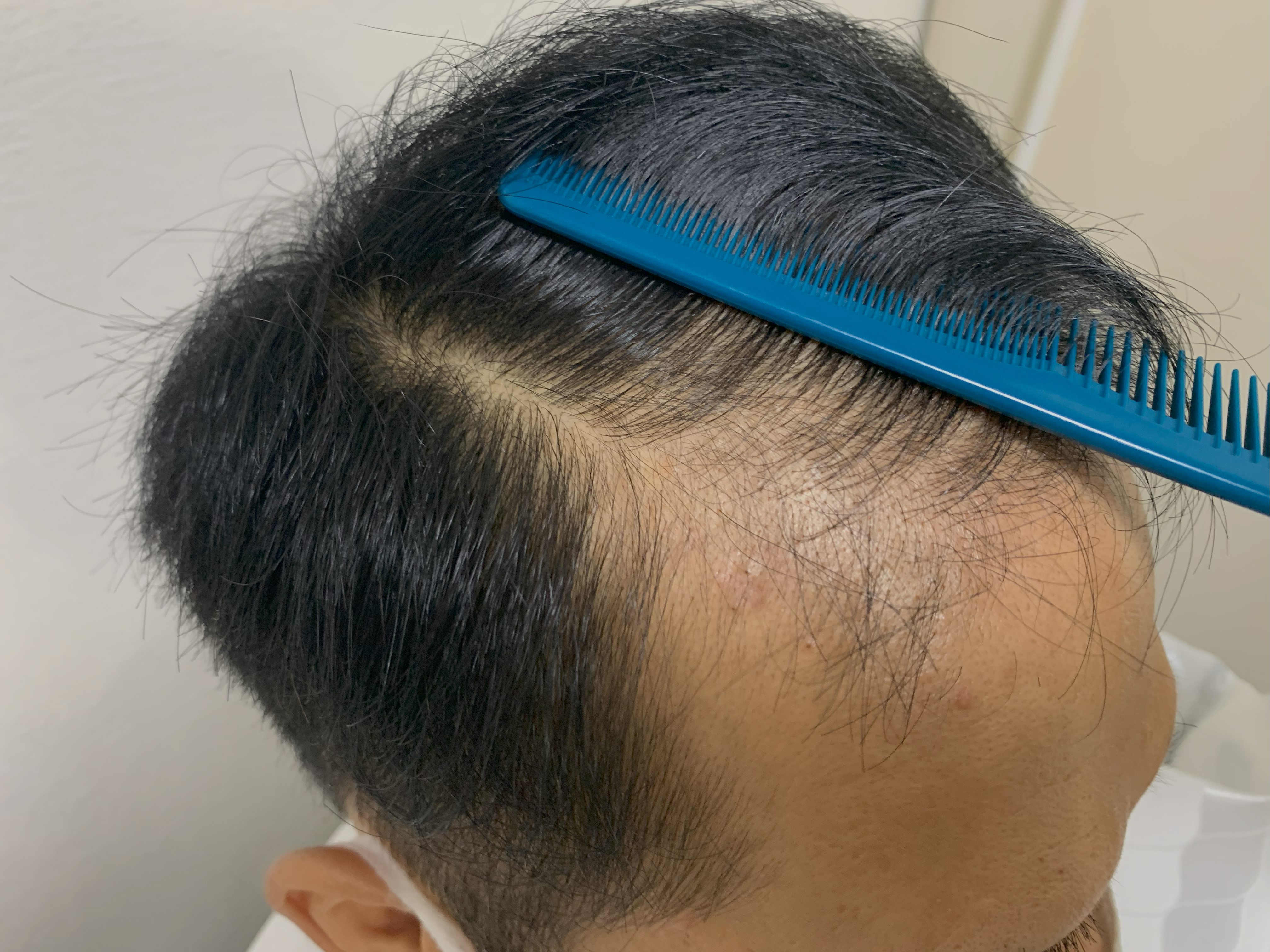 40代男性 右M字 スタート