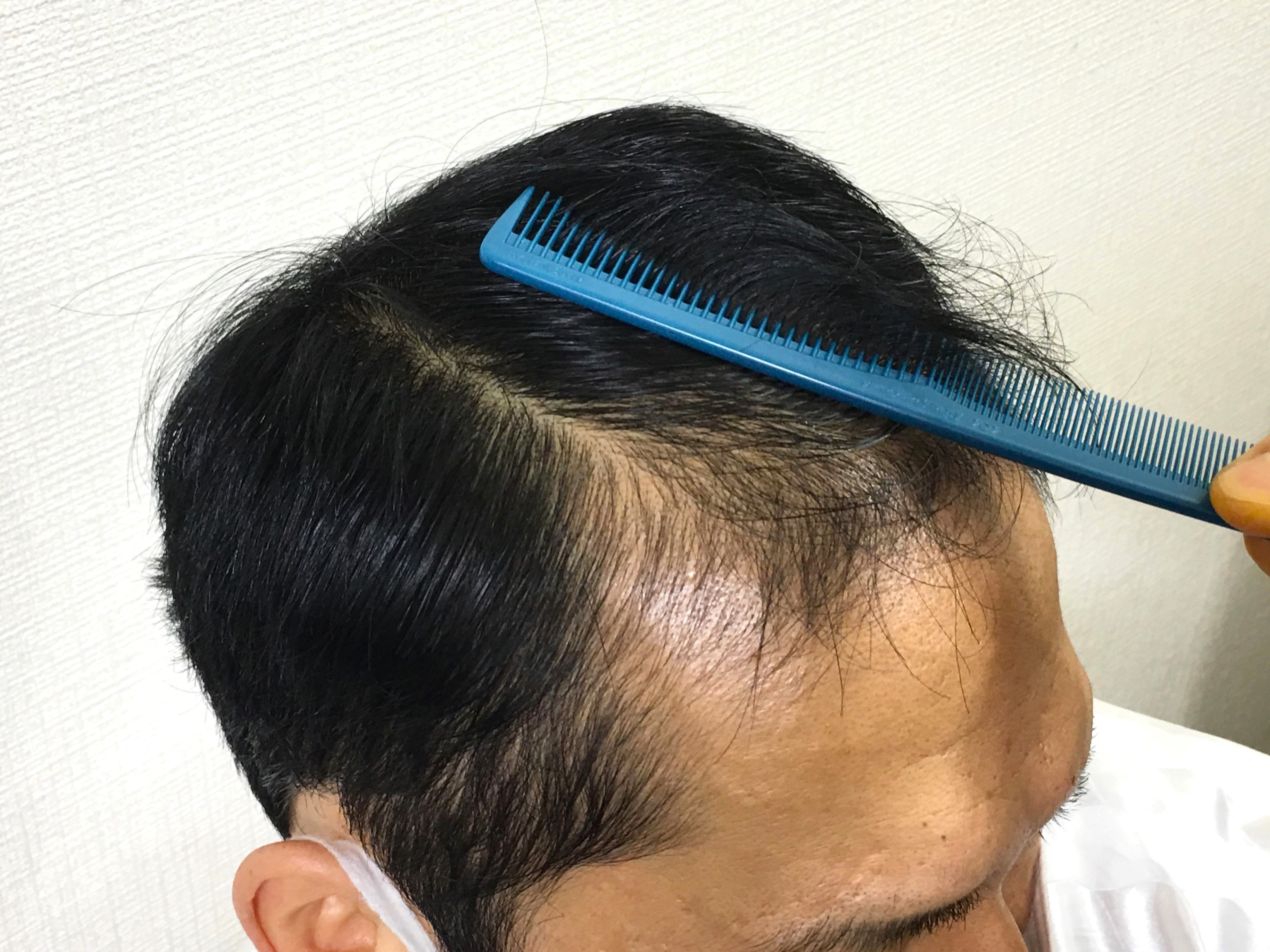 40代男性 右M字 2ヵ月