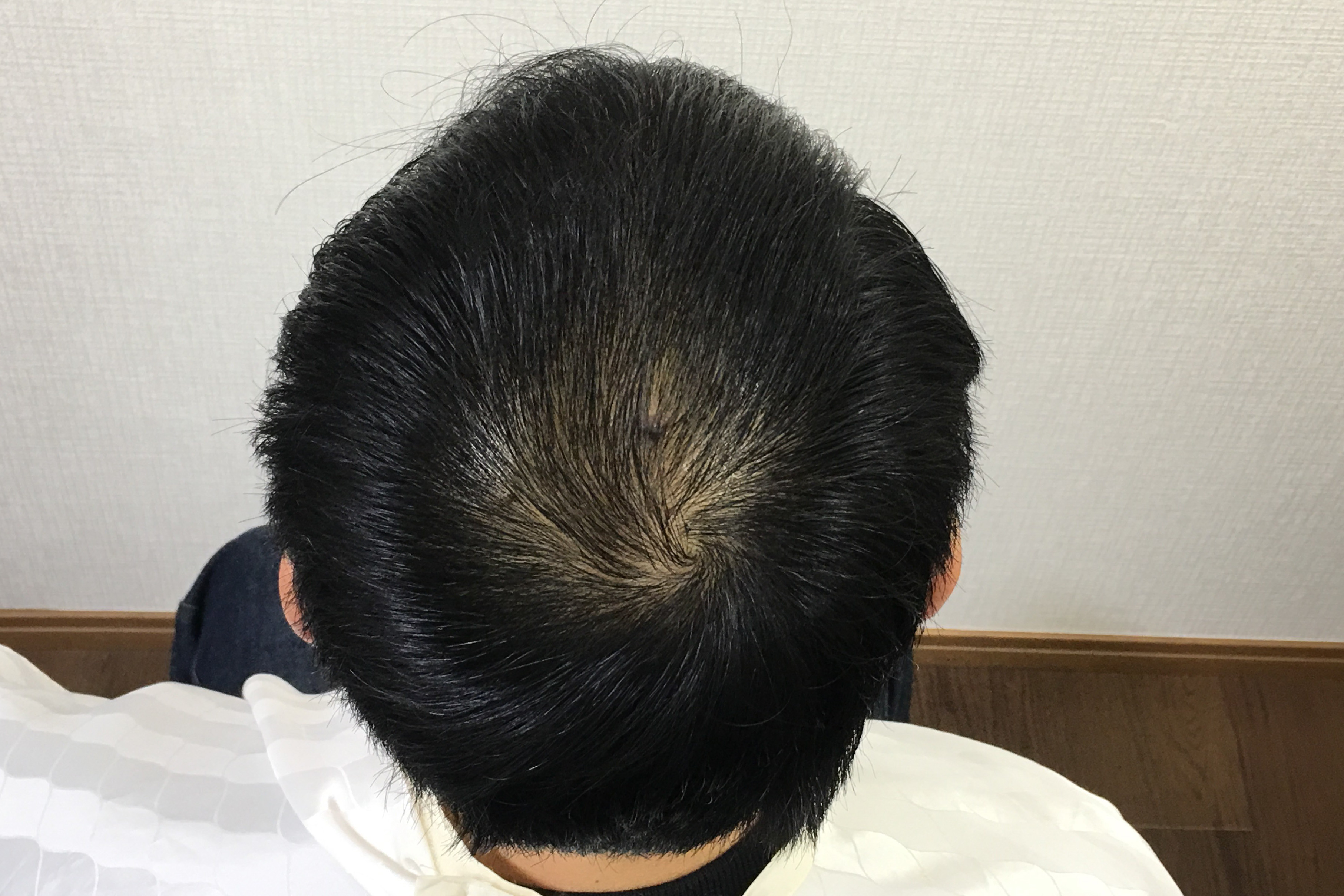 40代男性 頭頂部 2ヵ月