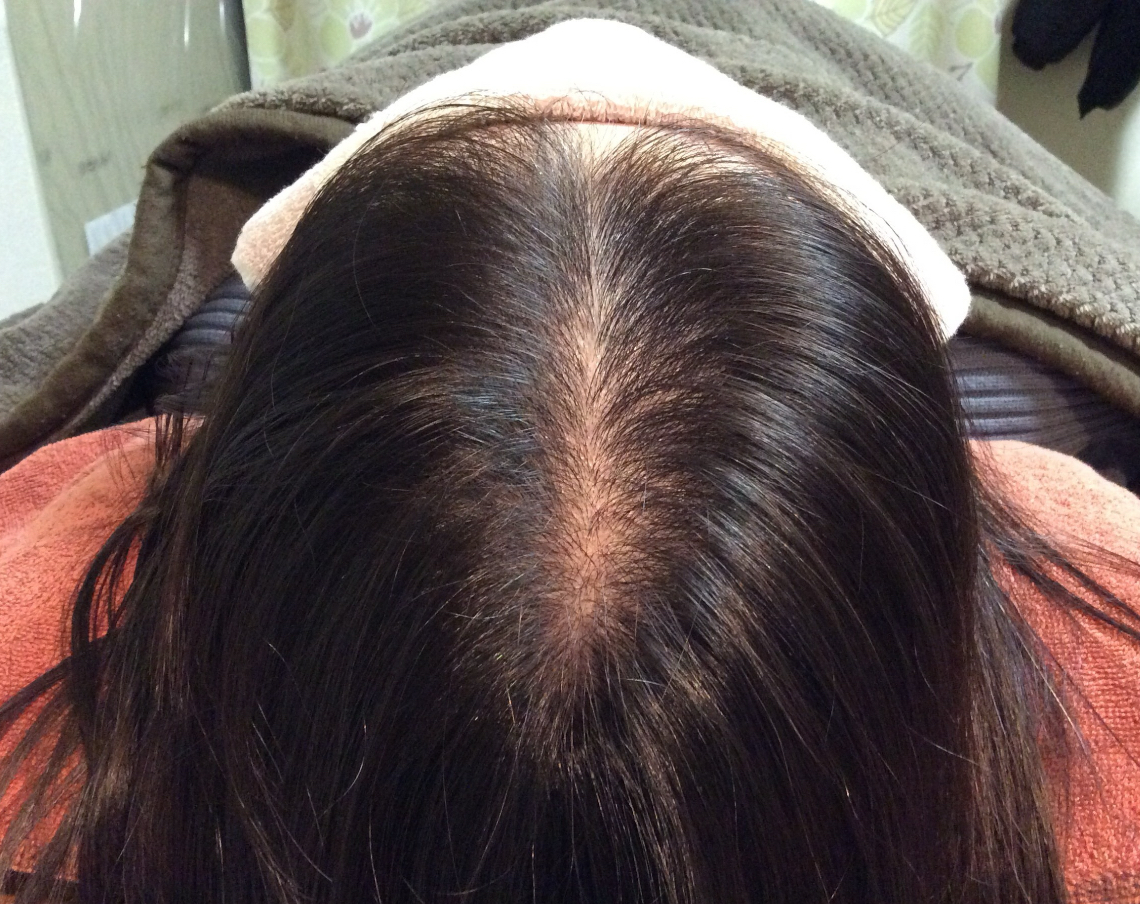 20代女性 頭頂部 途中