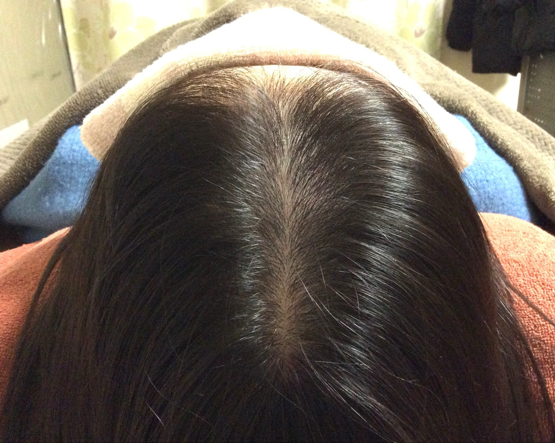 20代女性 頭頂部 経過
