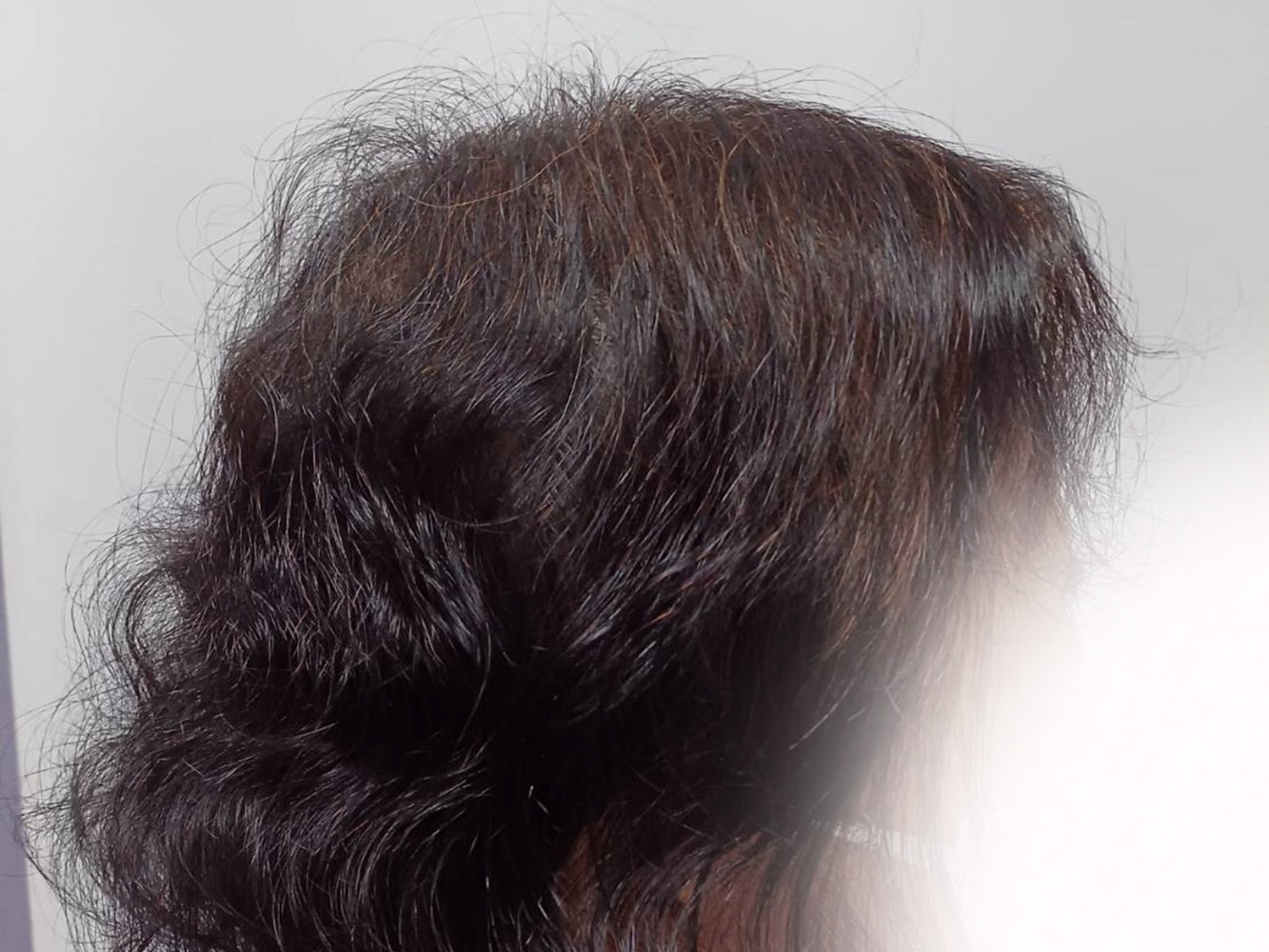 50代女性 右横 約9ヵ月