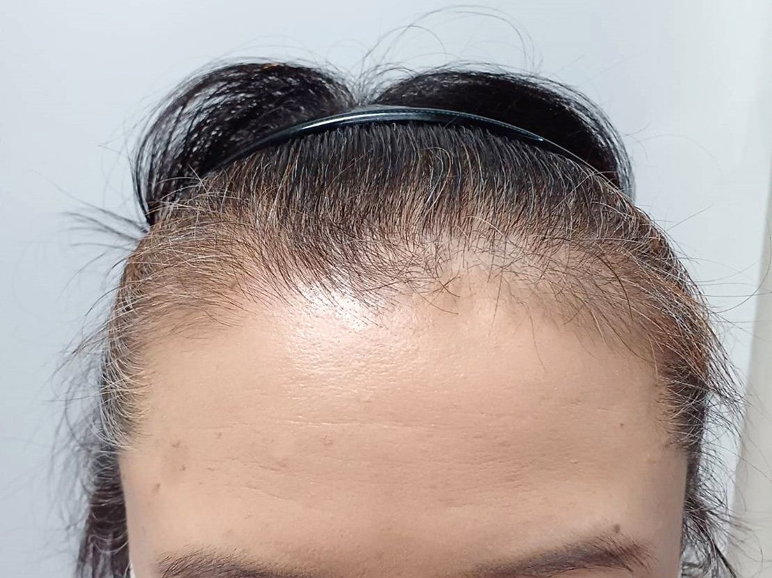 50代女性 正面生え際 スタート
