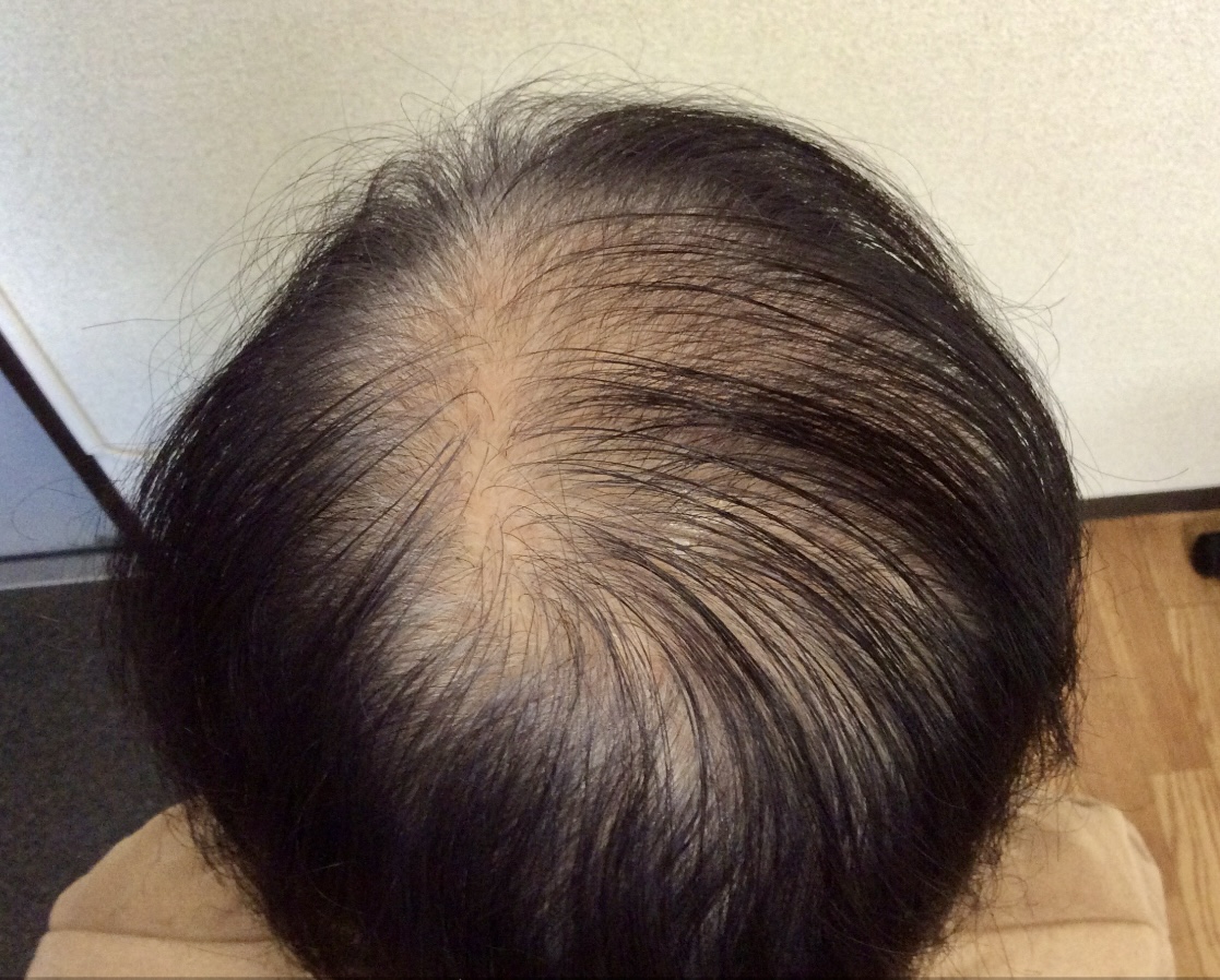 60代女性 頭頂部 途中