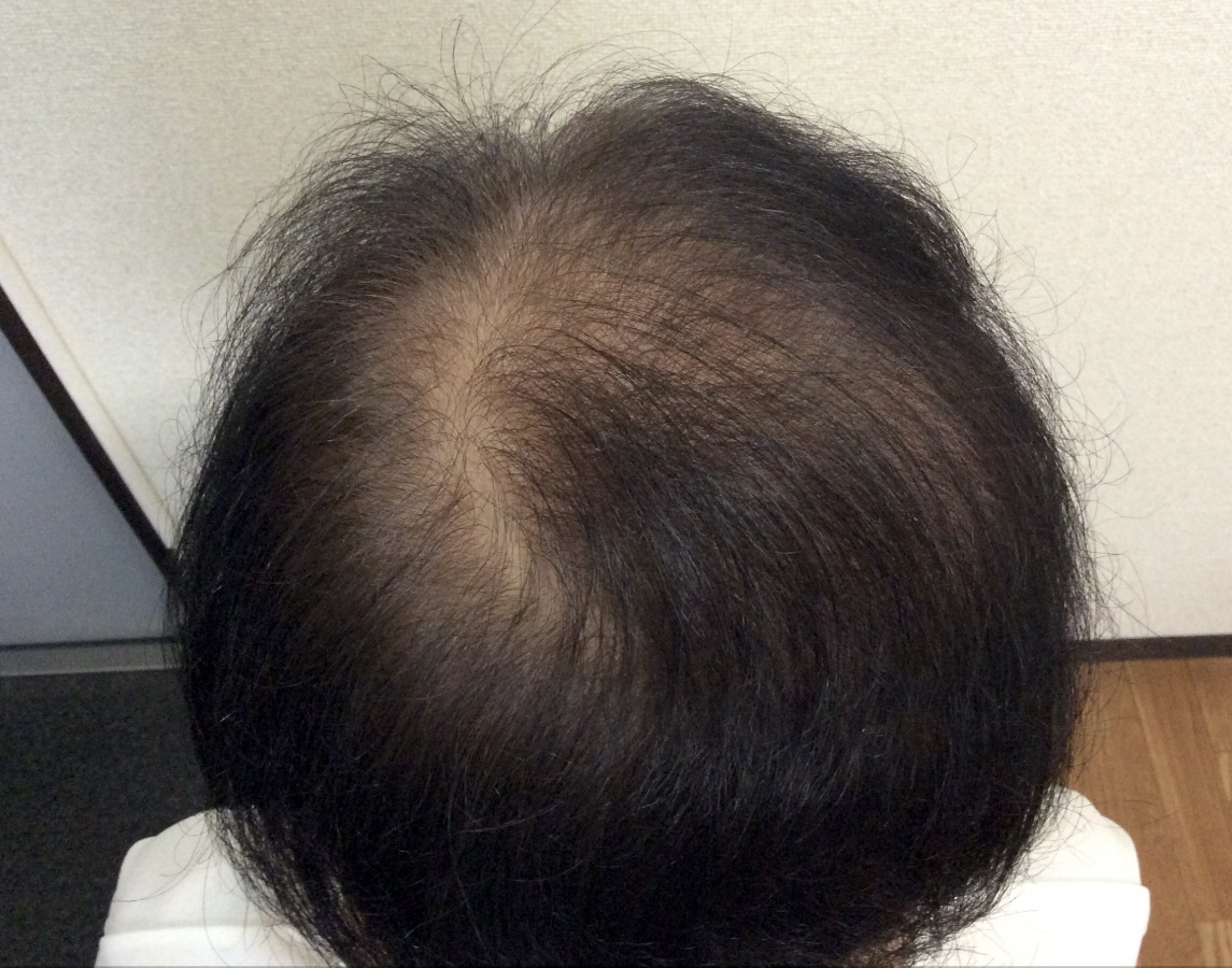 60代女性 頭頂部 5ヵ月