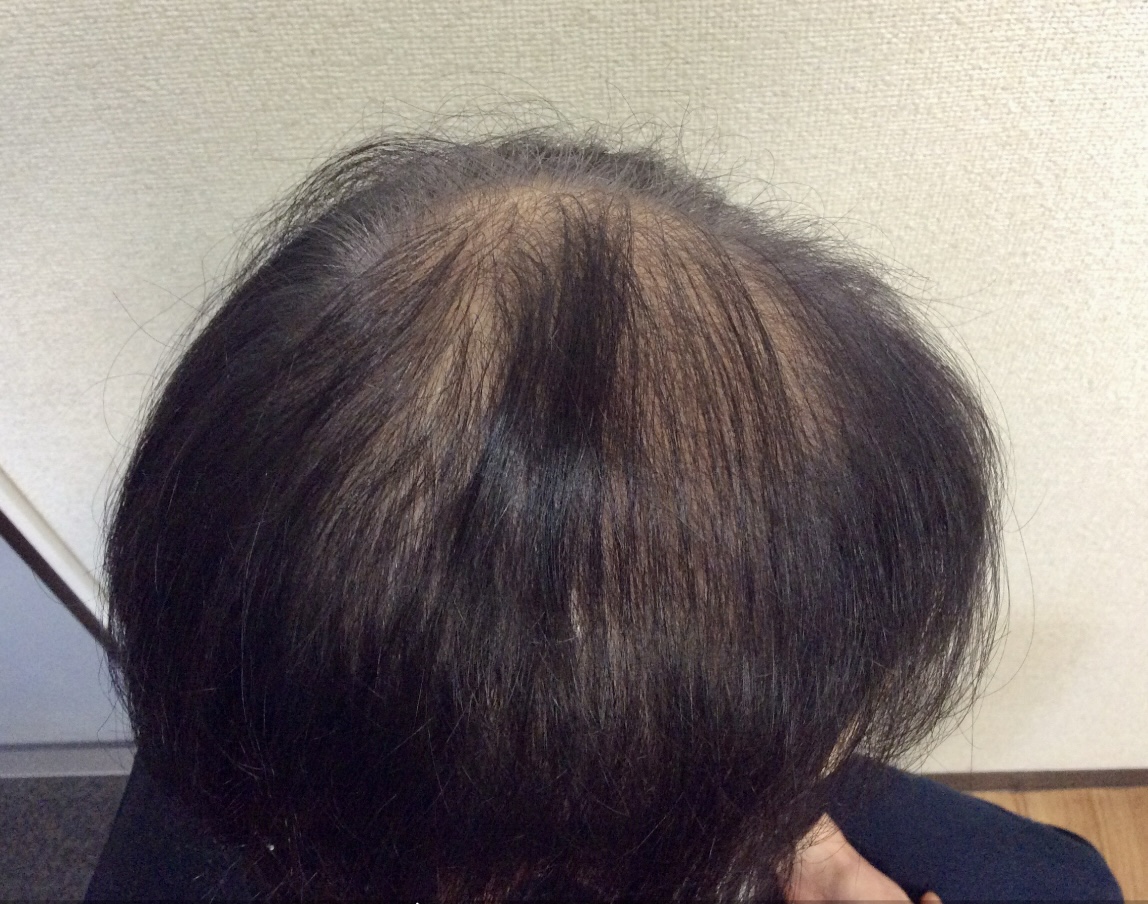 60代女性 側頭部 途中