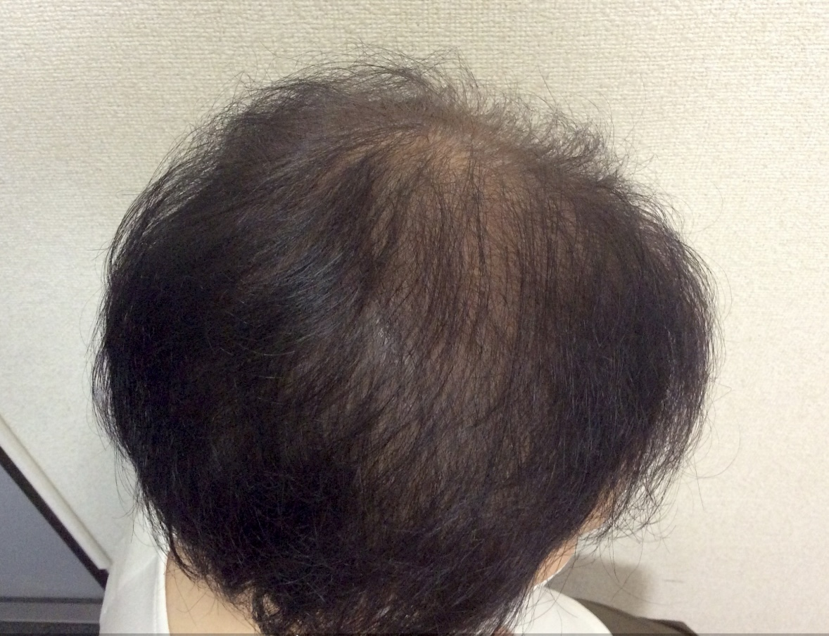 60代女性 側頭部 5ヵ月
