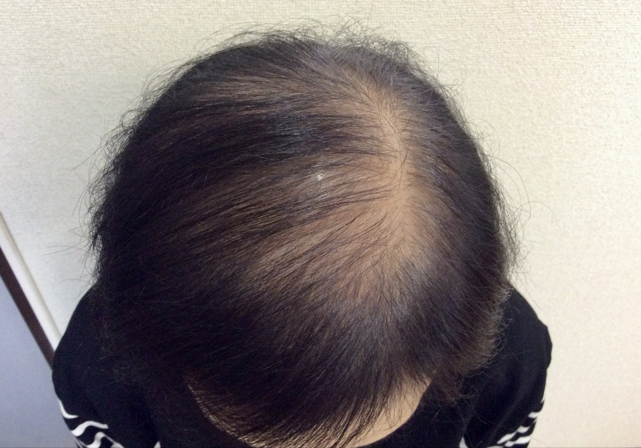 60代女性 前頭部 途中
