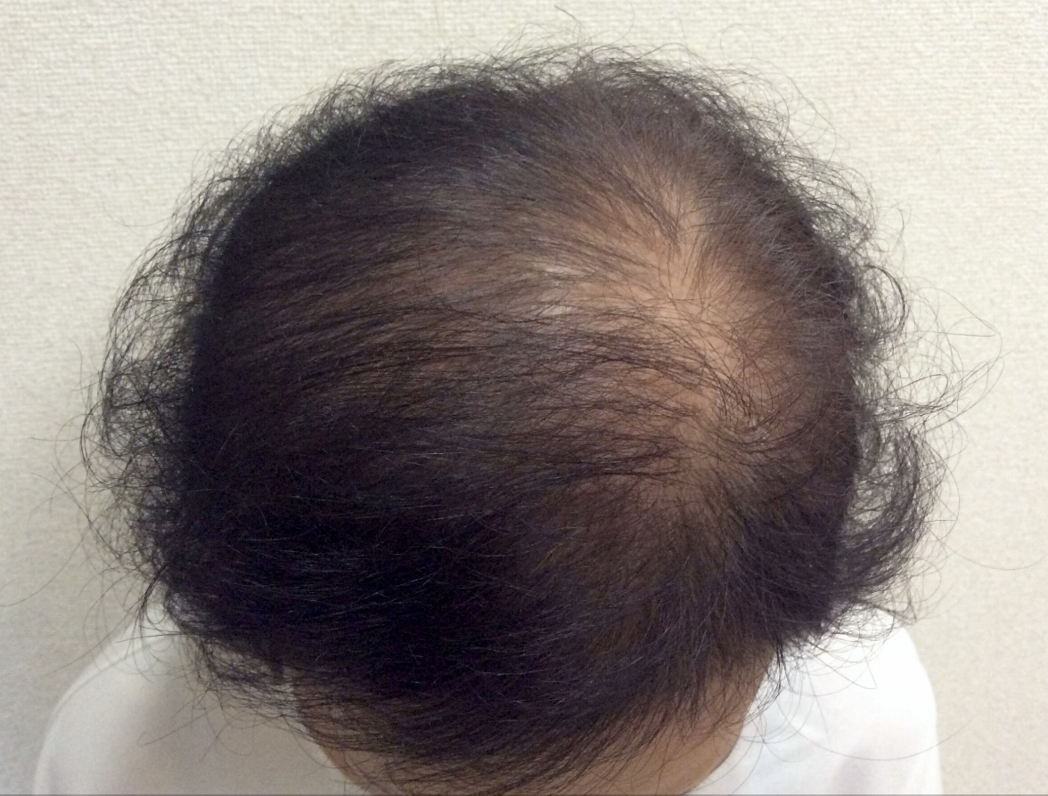 60代女性 前頭部 5ヵ月