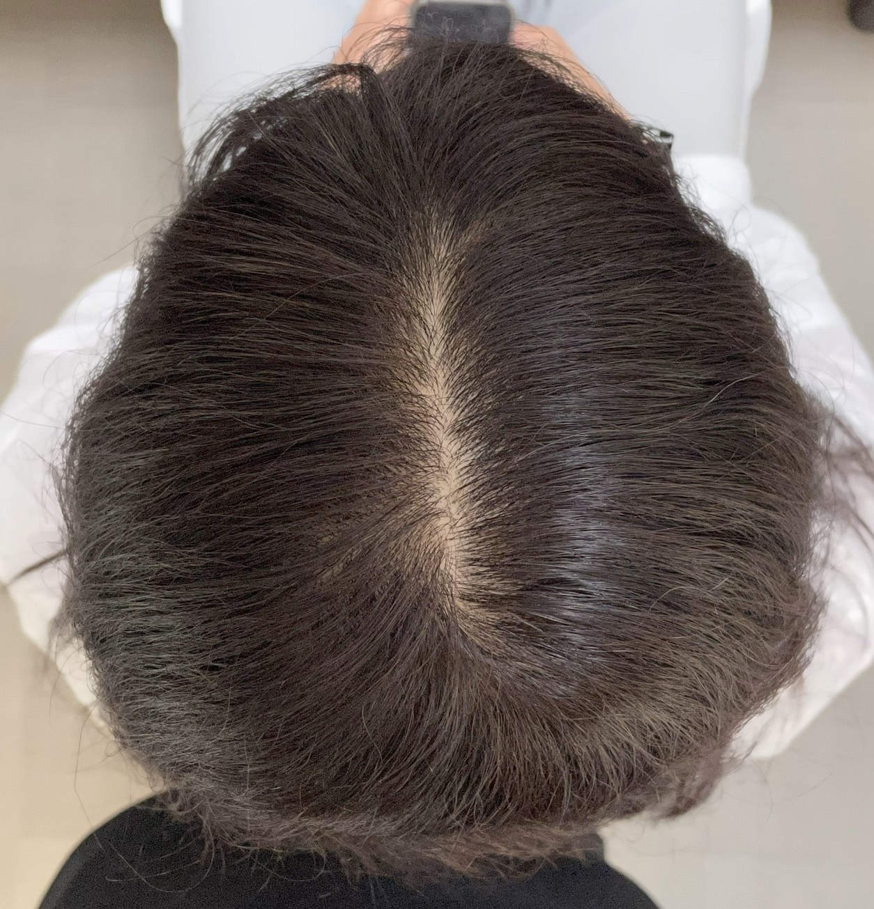 50代女性 頭頂部 7ヵ月