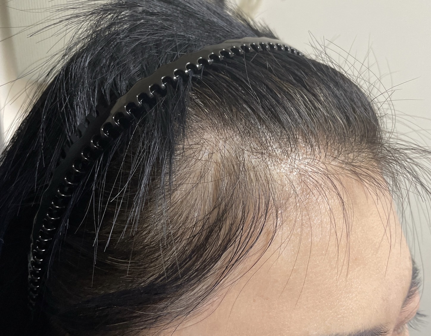 50代女性 生え際 スタート