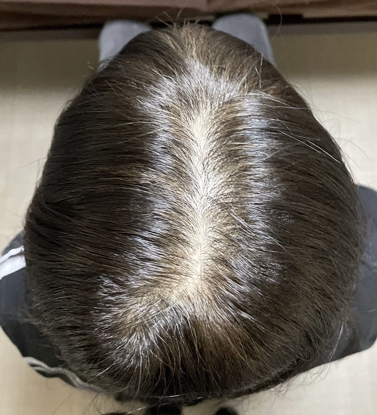 50代女性 頭頂部 スタート