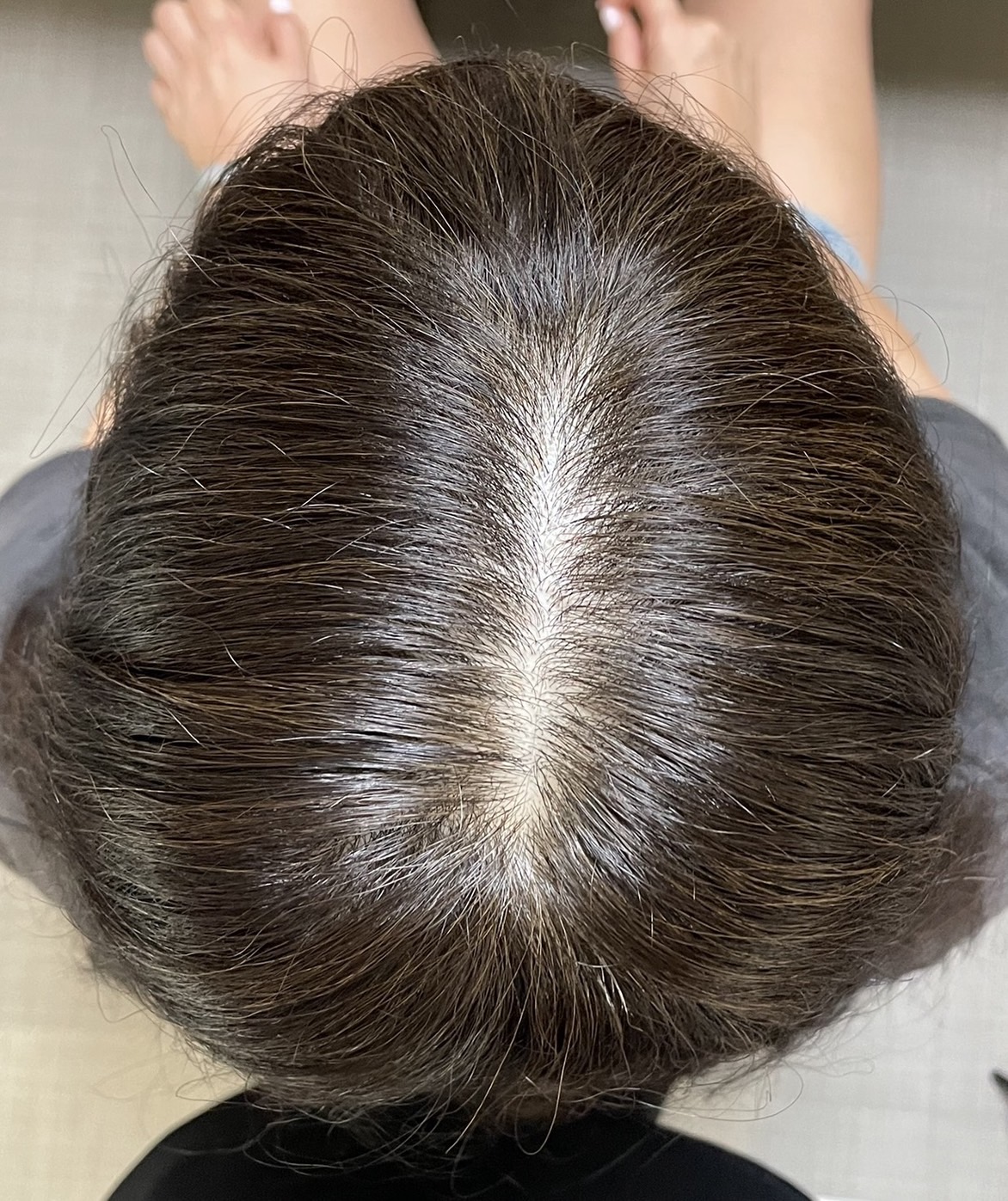 50代女性 頭頂部 3ヵ月